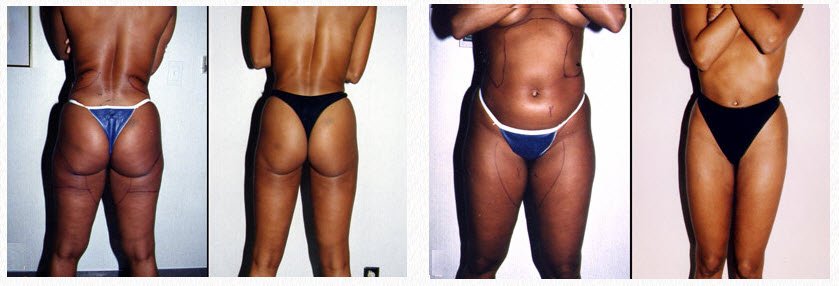 Liposuction Surgeon Los Angeles