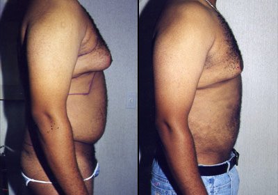 Men-liposuction-los-angeles